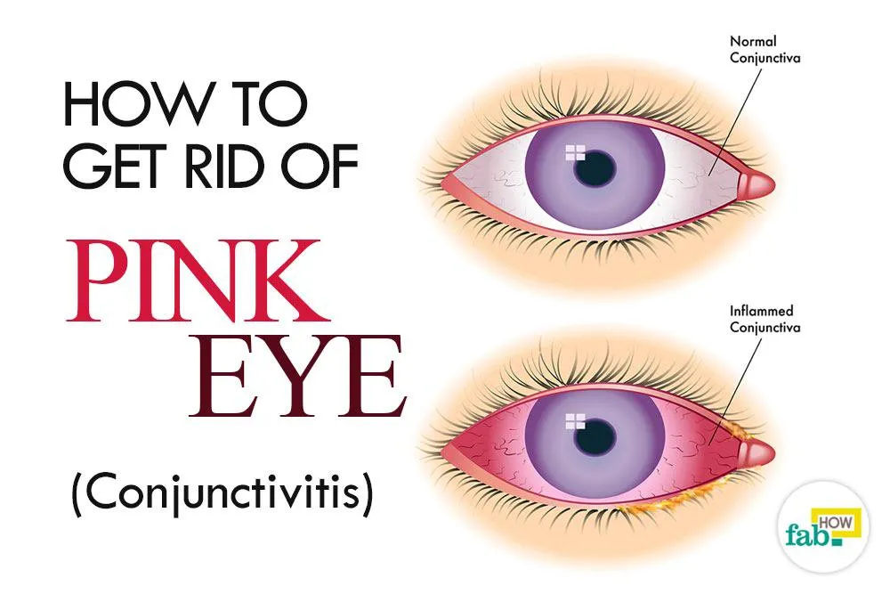 Castor oil is yet another anti microbial that acts as a natural remedy for pink eye. One or two drops twice a day can give better results.