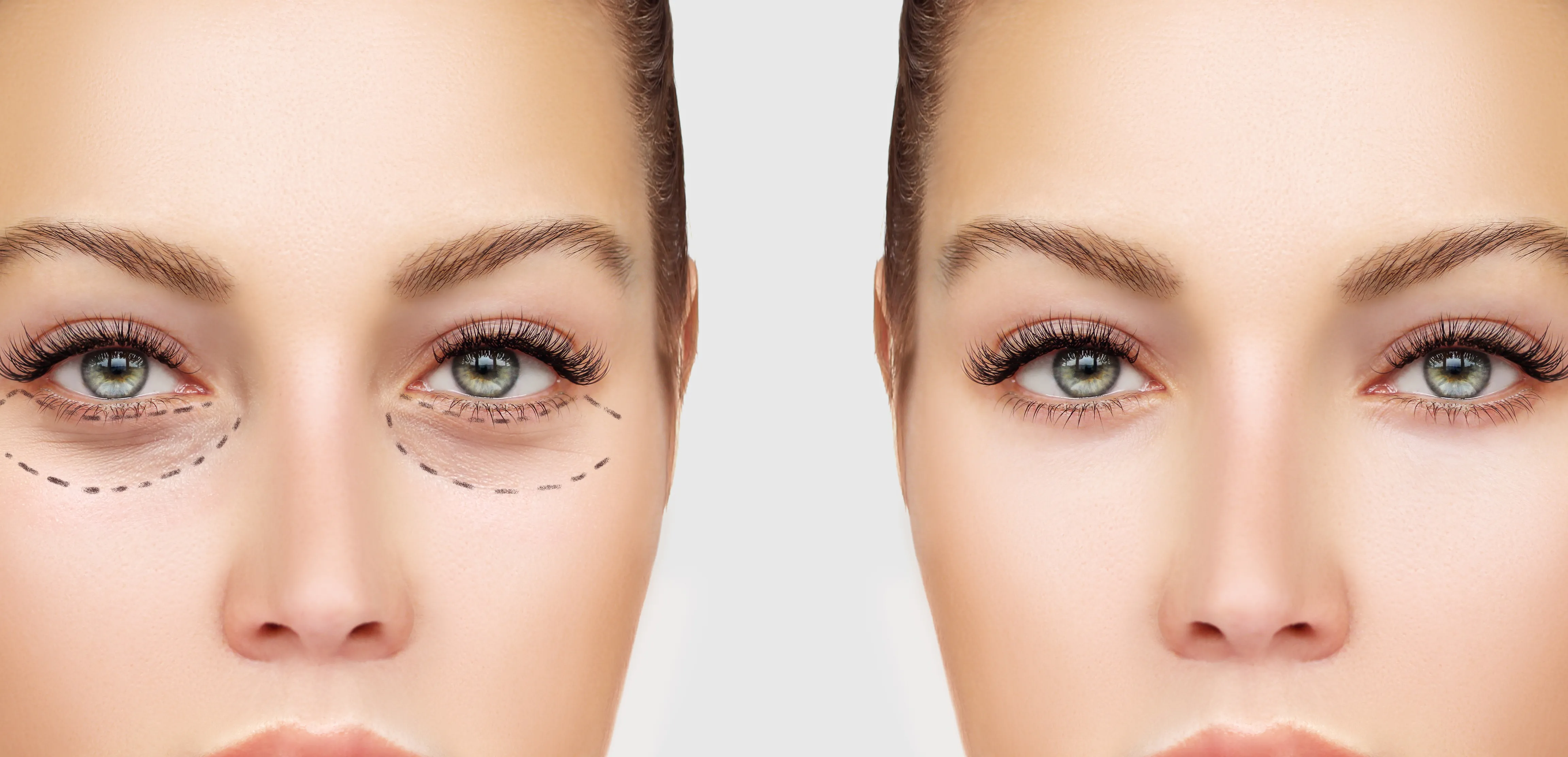 knowing about Blepharoplasty and its rising popularity