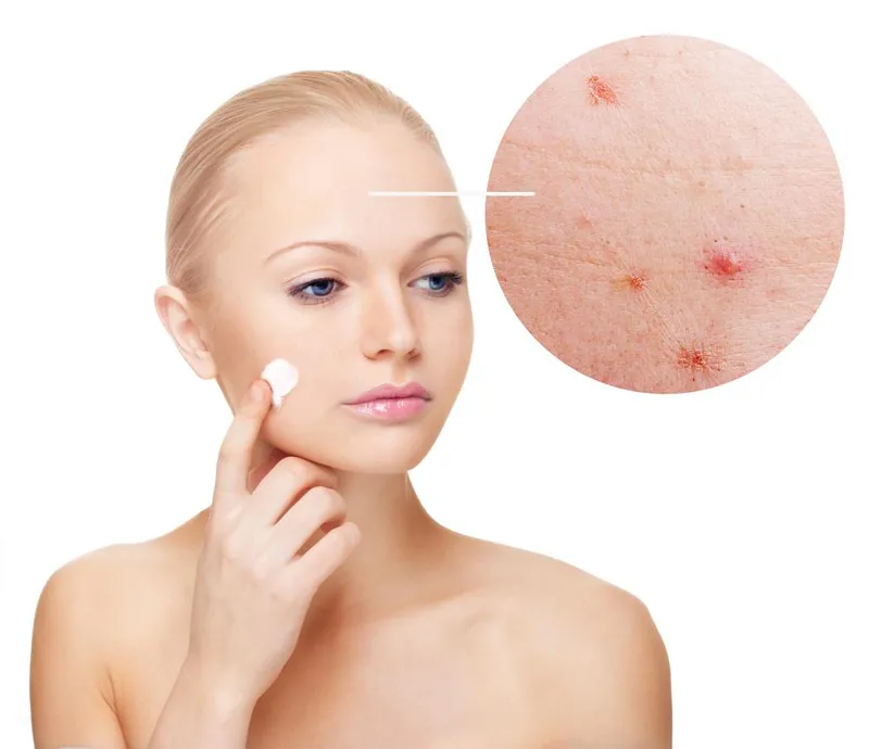 What is Acne Find the best acne cream for your type of acne with our useful tips.